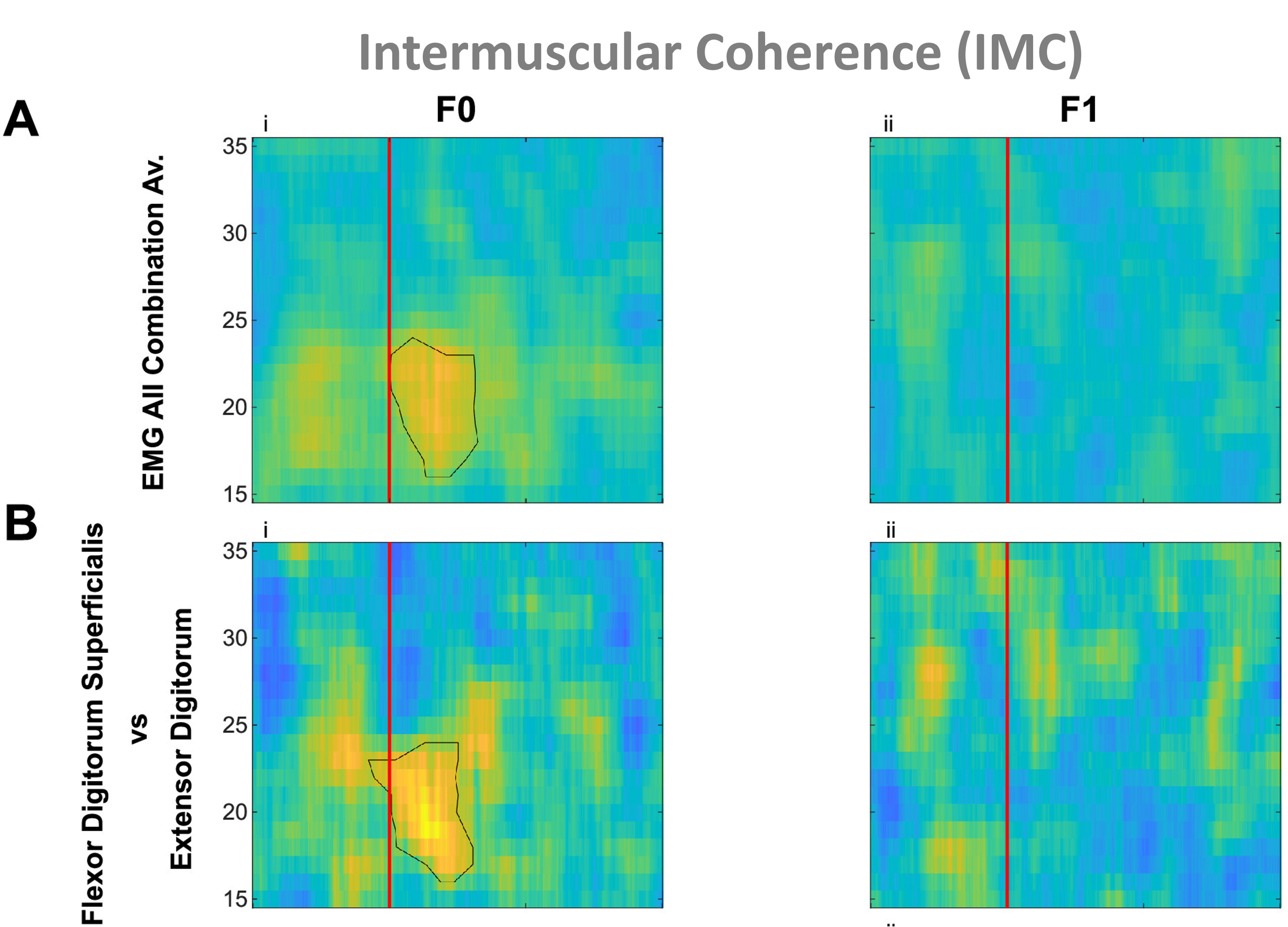 The figure shows sensorimotor beta bursts increased beta band corticomuscular coherence (CMC) and intermuscular coherence (IMC) across different muscle pairs, but only during static posture holding