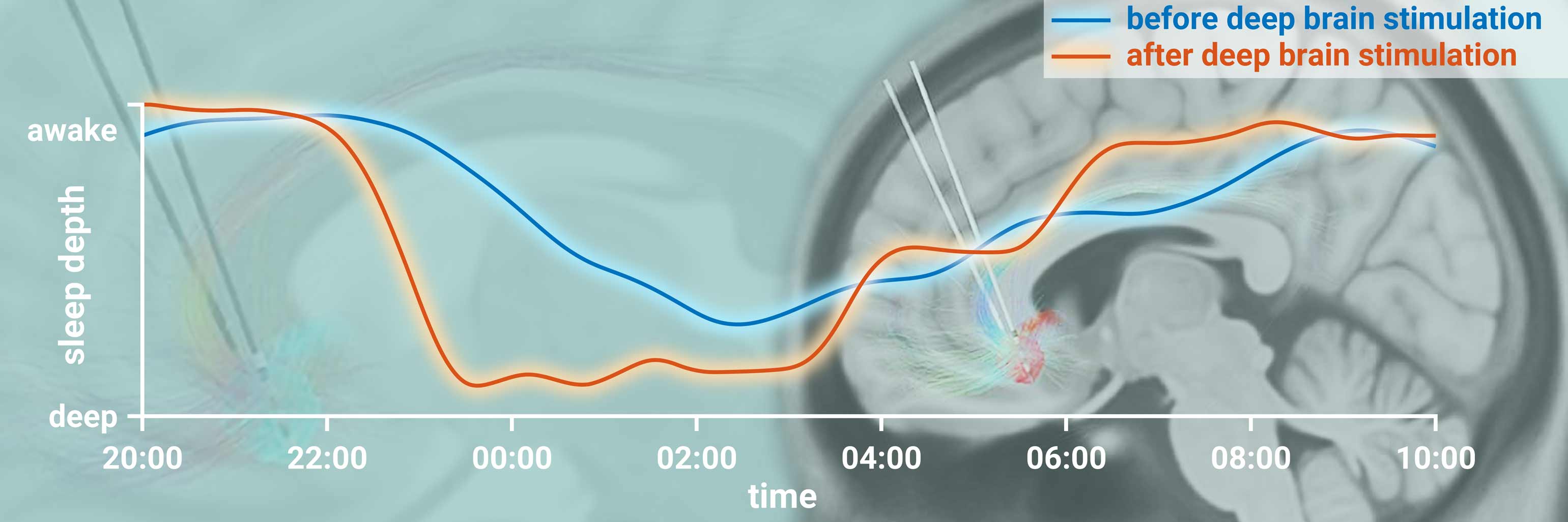 Graph of depth of sleep vs time in the night, showing post-DBS giving deeper sleep occurring earlier in the night than Pre-DBS; also a brain image from MRI showing the location of the DBS electrodes.