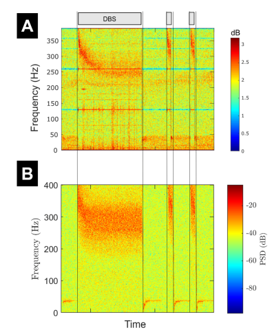 Spectrograms representing ERNA in patient data (top plot) and in the model (bottom plot). The slow frequency decay of ERNA is visible in orange, while background noise is in green. The model reproduces various features of ERNA for long and short stimulation durations.